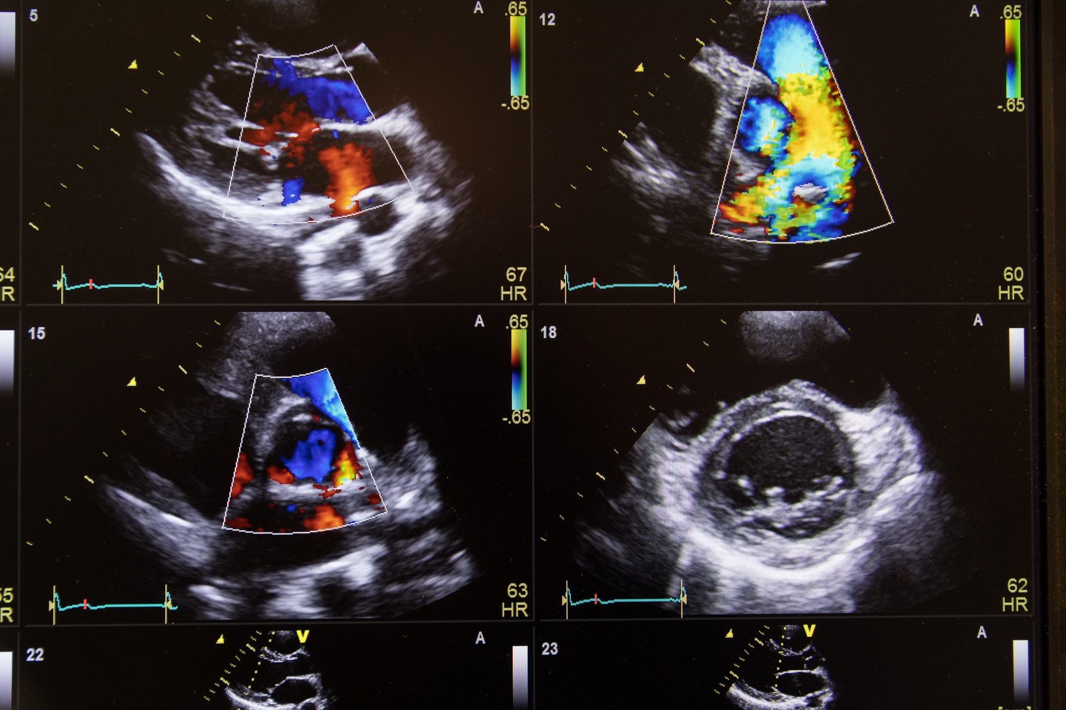 Heart ultrasound image